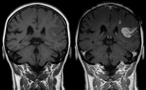 the villages mri with contrast|MRI with vs. without Contrast: A Patient’s Guide.